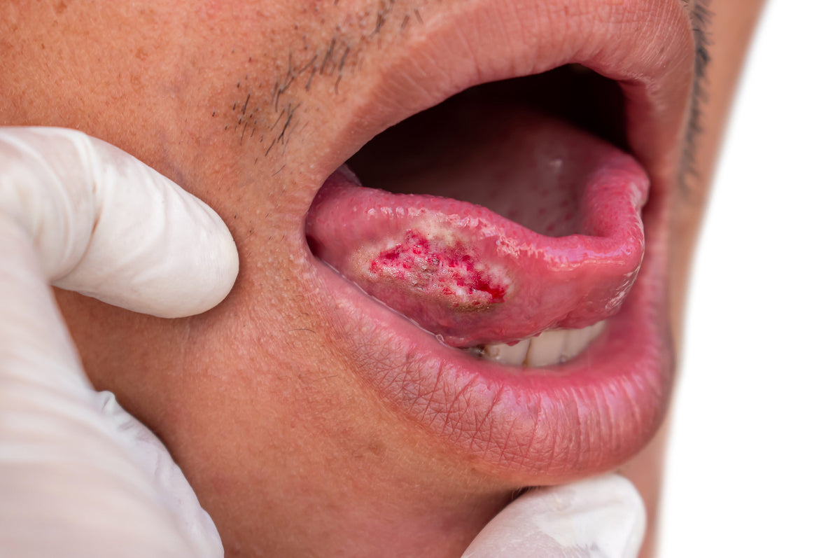 mouth cancer