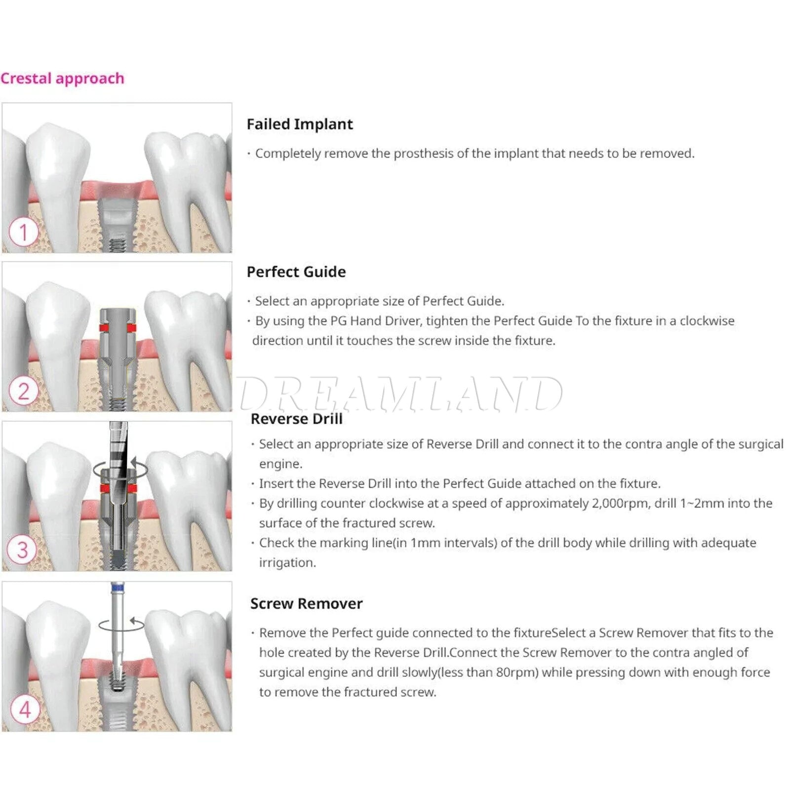 Dental Implant Screw Removal Kit Remove Drill Fractured Claw Revese Guide SRK